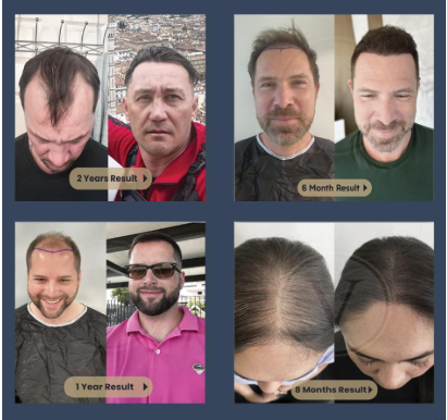 Istanbul Vita | The New Era of Hair Transplant in Turkey Istanbul Vita | The New Era of Hair Transplant in Turkey