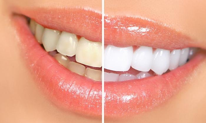 Teeth Whitening Process Post Invisalign for Sensitive Teeth Teeth Whitening Process Post Invisalign for Sensitive Teeth