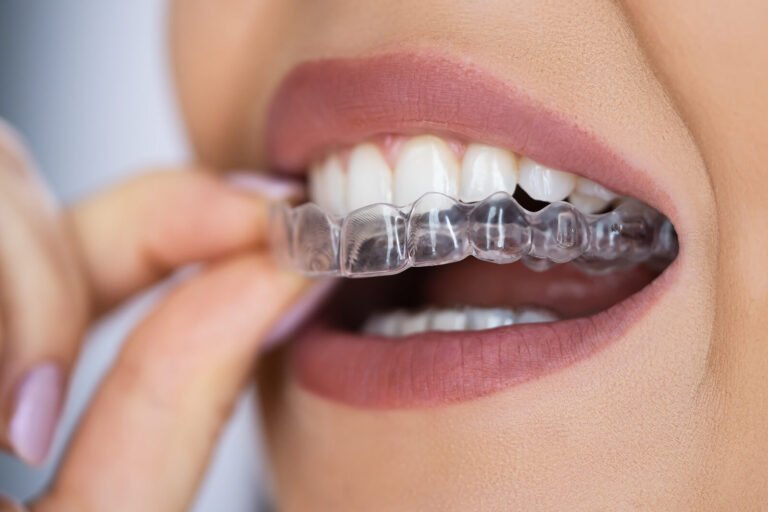 Are Clear Aligners the Best Way to Straighten Your Smile Discreetly in the UK?