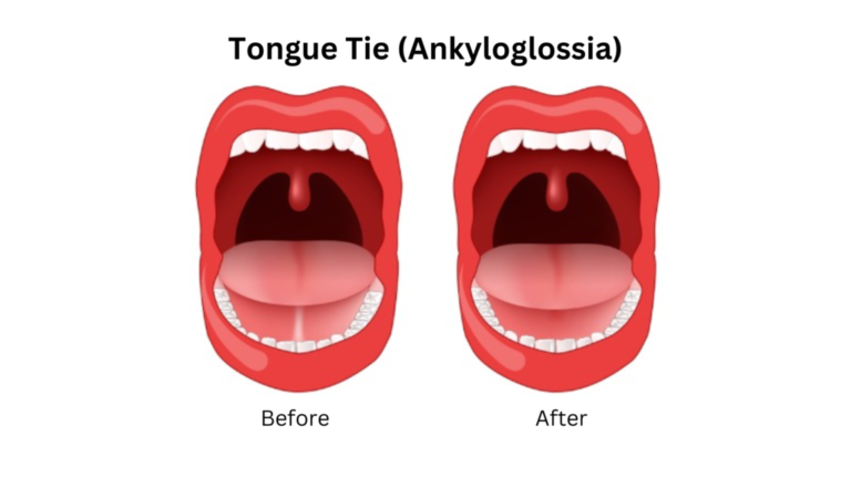 What Exactly is a Tongue-Tie Release and When is it Necessary? What Exactly is a Tongue-Tie Release and When is it Necessary?