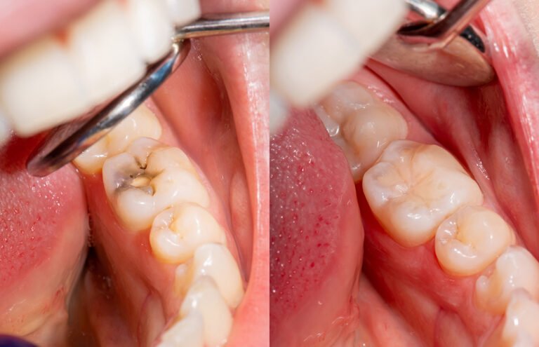 Are White Fillings Worth It? Key Advantages You Should Know