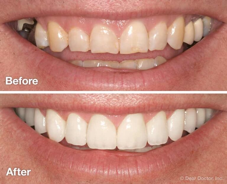 Every smile makeover begins with a detailed consultation with The Dental Revolution practice. This is where you can explain what you would