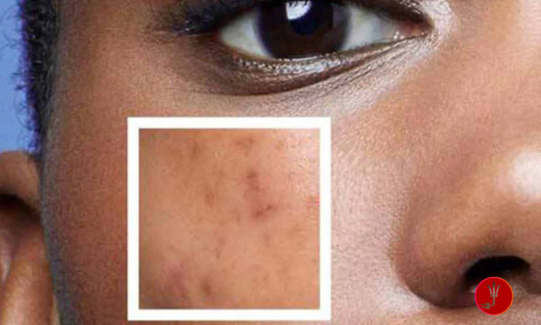 I Am a College Student. Are La Roche-Posay Products Better for Acne-Prone Skin Than Neutrogena? A Complete Guide am a college student. are la roche-posay products better for acne-prone skin than neutrogena?